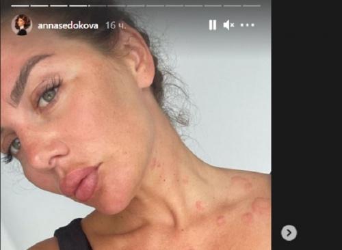 Анна Седокова показала, как изменилась из-за болезни 1