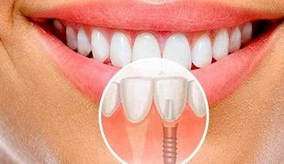 Современная Имплантация зубов залог вашей белоснежной улыбки