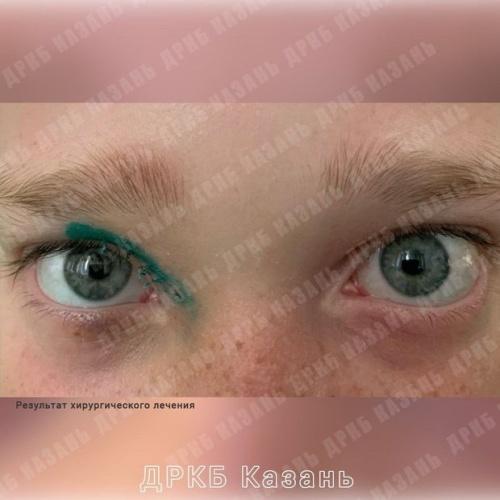 Офтальмологи ДРКБ удалили ребенку дермоидную кисту над глазом1