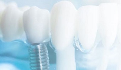 Современные импланты для зубов