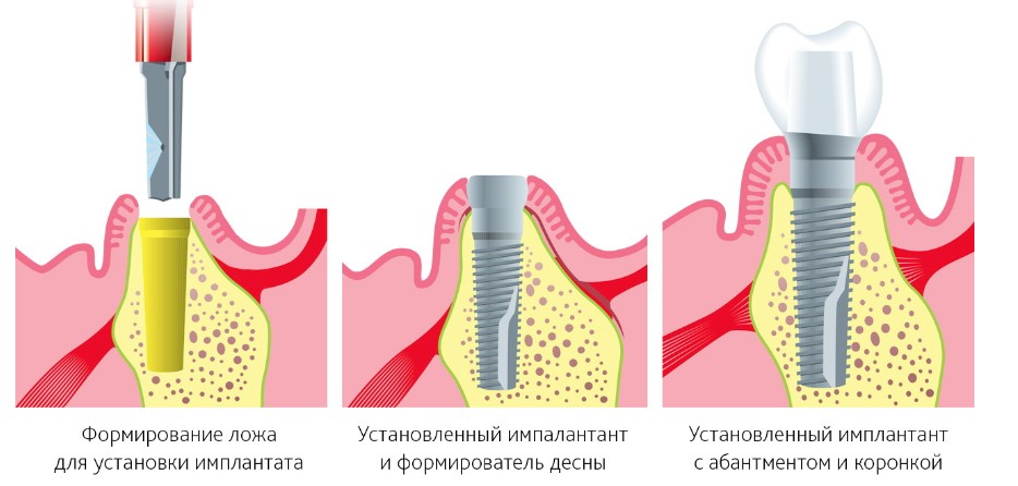 Какие существуют противопоказания для установки зубных имплантов