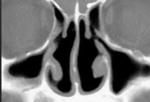 Драматическая попытка самоубийства после операции на носу: