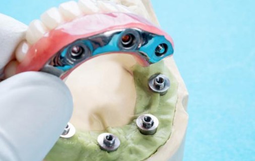 Современная методика восстановления "Зубы за один день"