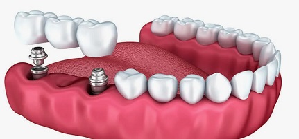Что лучше: мосты или импланты на зубы?