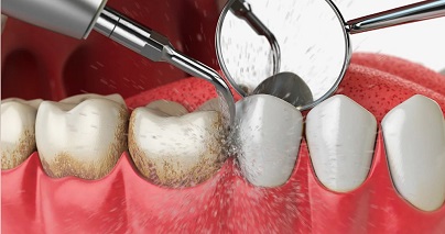 Air Flow Инновационный способ чистки зубов