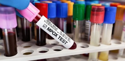 ВОЗ объявила чрезвычайную ситуацию из-за вспышки оспы обезьян