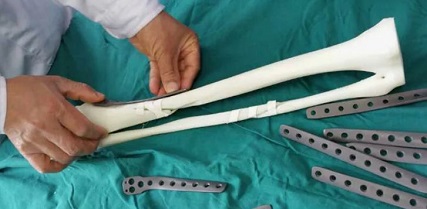 Как выбрать титановую пластину на ногу при переломе