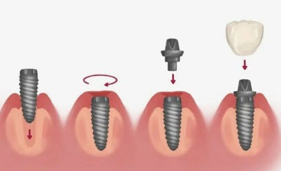 Имплантация зубов под ключ: этапы, показания и преимущества метода