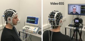 Разница между обычной ЭЭГ и ЭЭГ с видеомониторингом: преимущества и показания