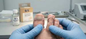 Скобы и пластины для коррекции ногтя: честное сравнение